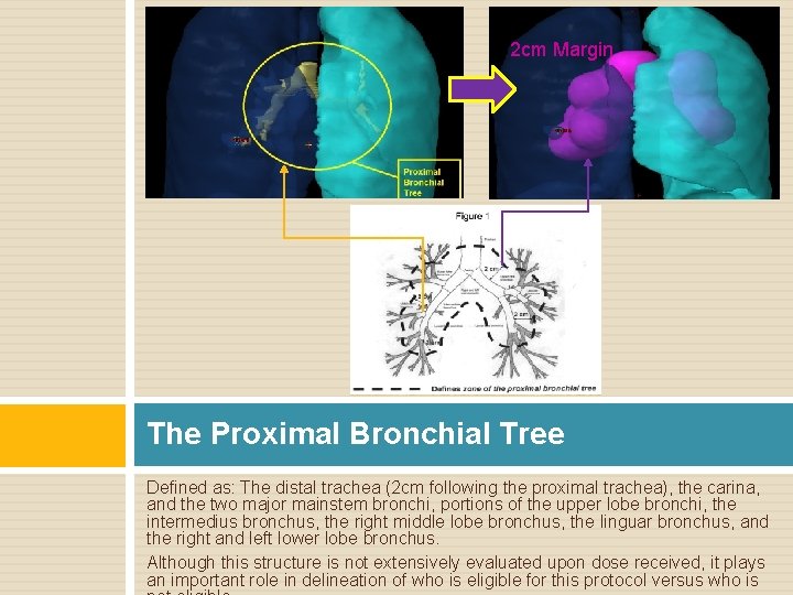 2 cm Margin The Proximal Bronchial Tree Defined as: The distal trachea (2 cm
