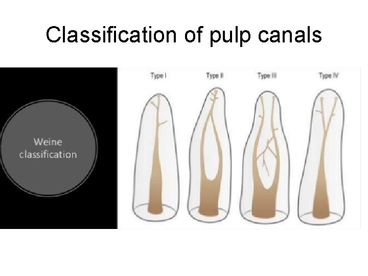 Classification of pulp canals 