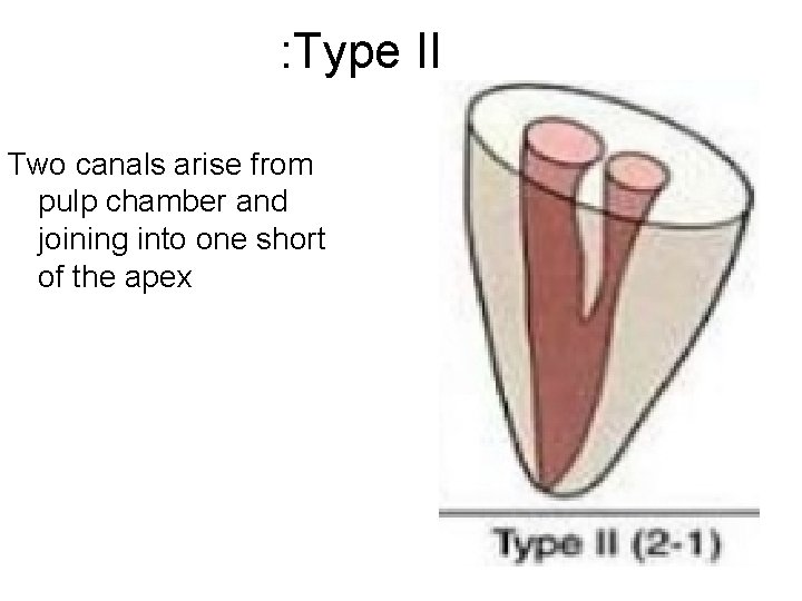 : Type II Two canals arise from pulp chamber and joining into one short