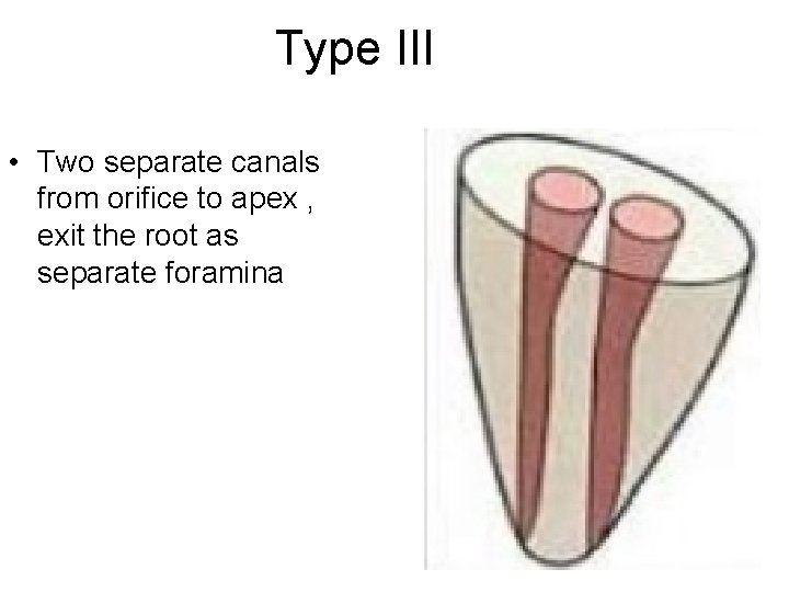Type III • Two separate canals from orifice to apex , exit the root