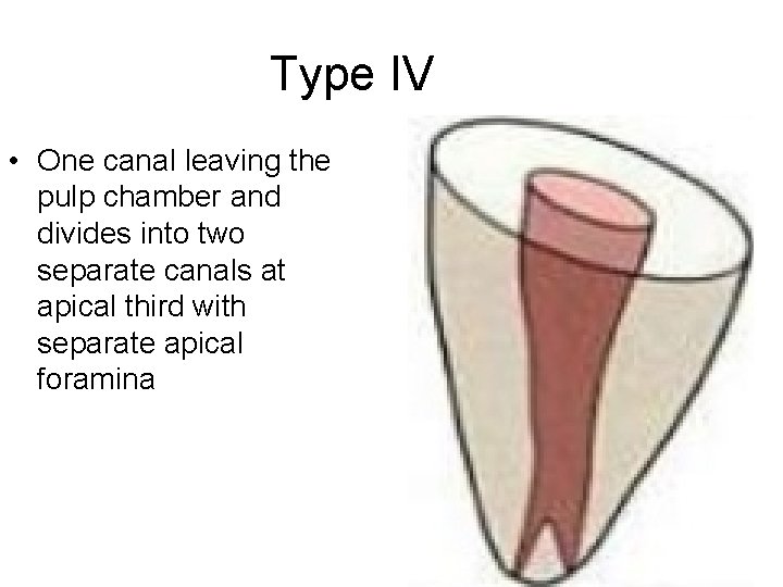 Type IV • One canal leaving the pulp chamber and divides into two separate