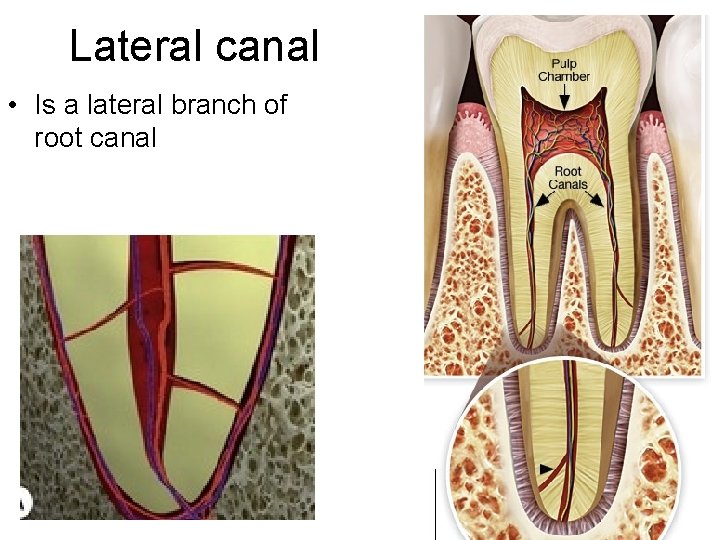 Lateral canal • Is a lateral branch of root canal 