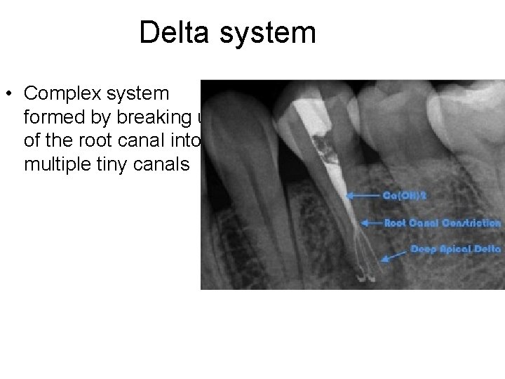 Delta system • Complex system formed by breaking up of the root canal into