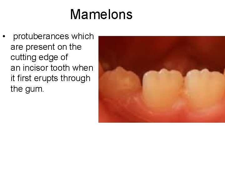 Mamelons • protuberances which are present on the cutting edge of an incisor tooth