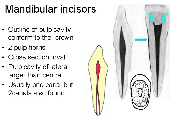 Mandibular incisors • Outline of pulp cavity conform to the crown • 2 pulp