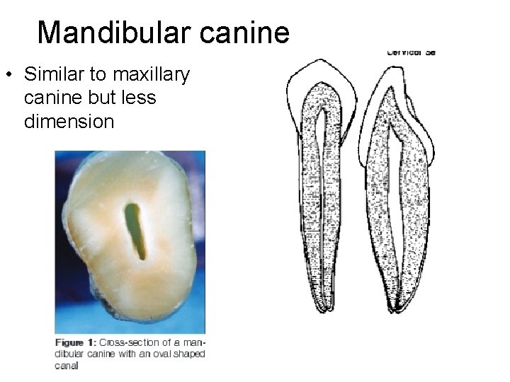 Mandibular canine • Similar to maxillary canine but less dimension 