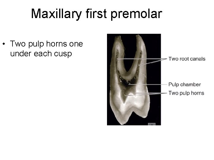 Maxillary first premolar • Two pulp horns one under each cusp 