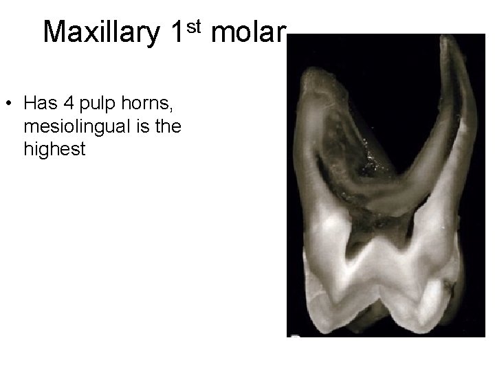 Maxillary 1 st molar • Has 4 pulp horns, mesiolingual is the highest 