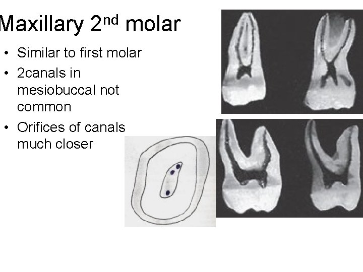 Maxillary 2 nd molar • Similar to first molar • 2 canals in mesiobuccal