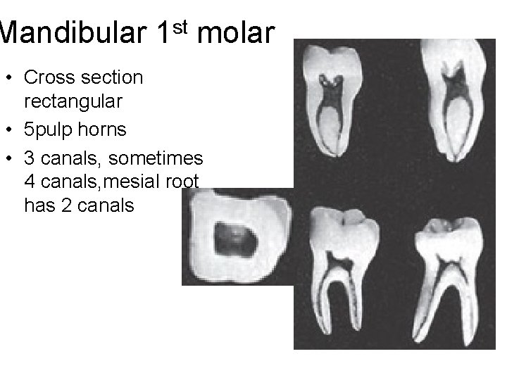 Mandibular 1 st molar • Cross section rectangular • 5 pulp horns • 3