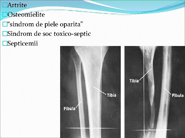 �Artrite �Osteomielite �“sindrom de piele oparita” �Sindrom de soc toxico-septic �Septicemii 