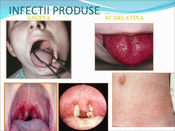 INFECTII PRODUSE ANGINA SCARLATINA 