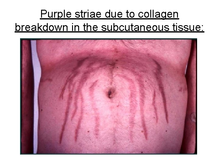 Purple striae due to collagen breakdown in the subcutaneous tissue: 