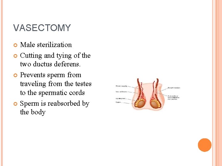 VASECTOMY Male sterilization Cutting and tying of the two ductus deferens. Prevents sperm from