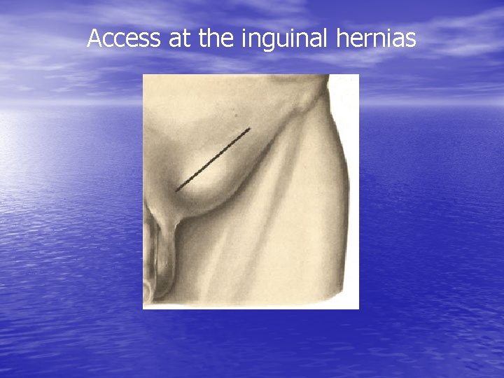 Access at the inguinal hernias 