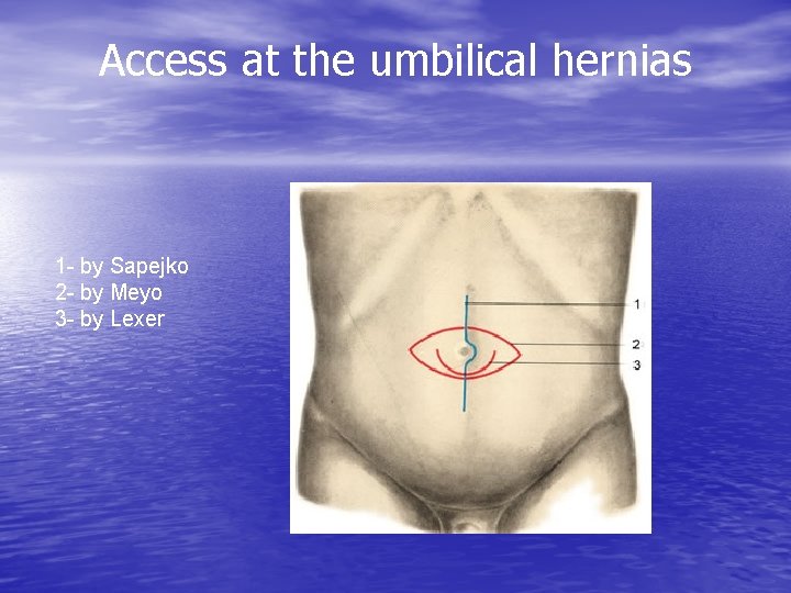 Access at the umbilical hernias 1 - by Sapejko 2 - by Meyo 3