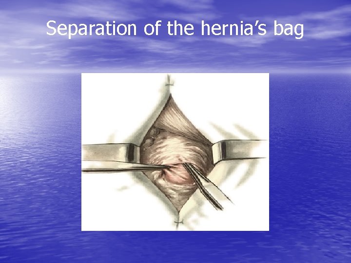 Separation of the hernia’s bag 