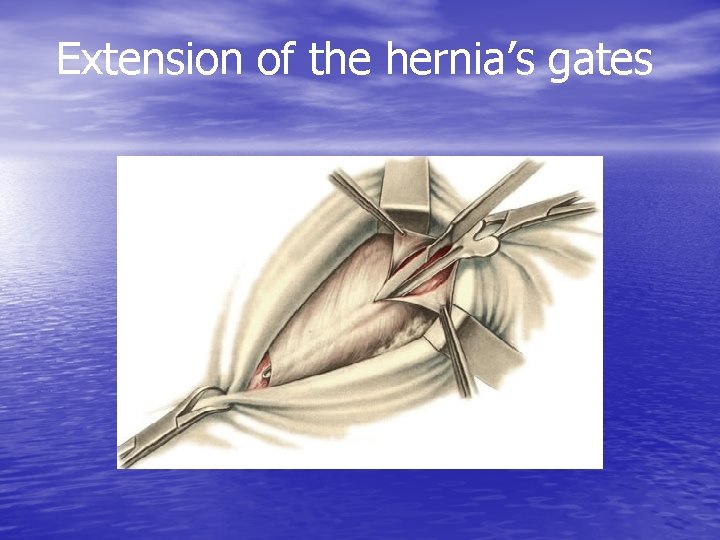 Extension of the hernia’s gates 