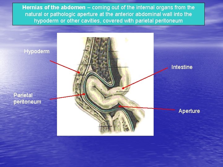 Hernias of the abdomen – coming out of the internal organs from the natural