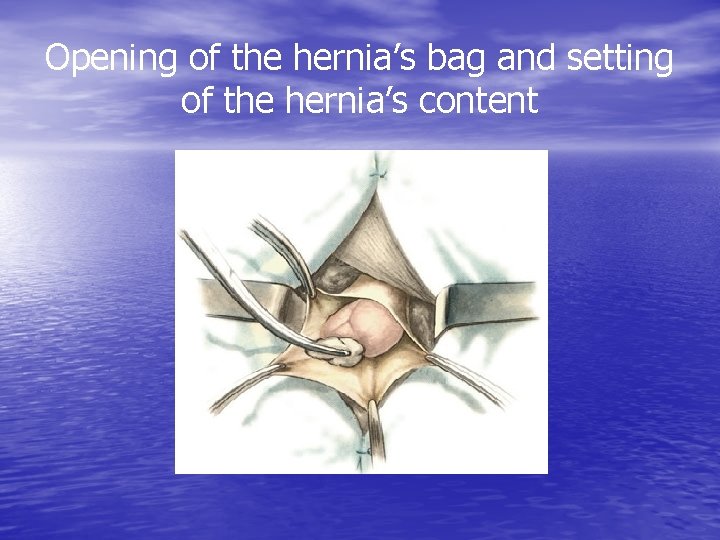 Opening of the hernia’s bag and setting of the hernia’s content 