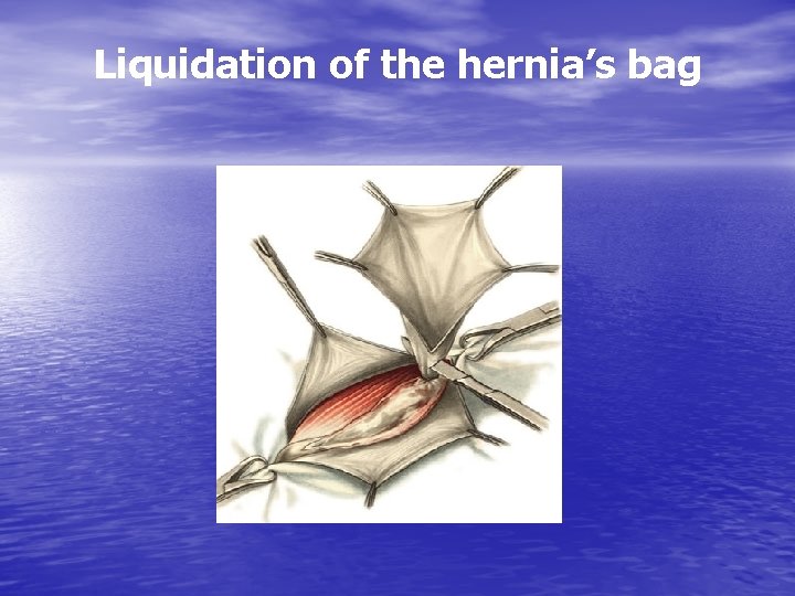 Liquidation of the hernia’s bag 