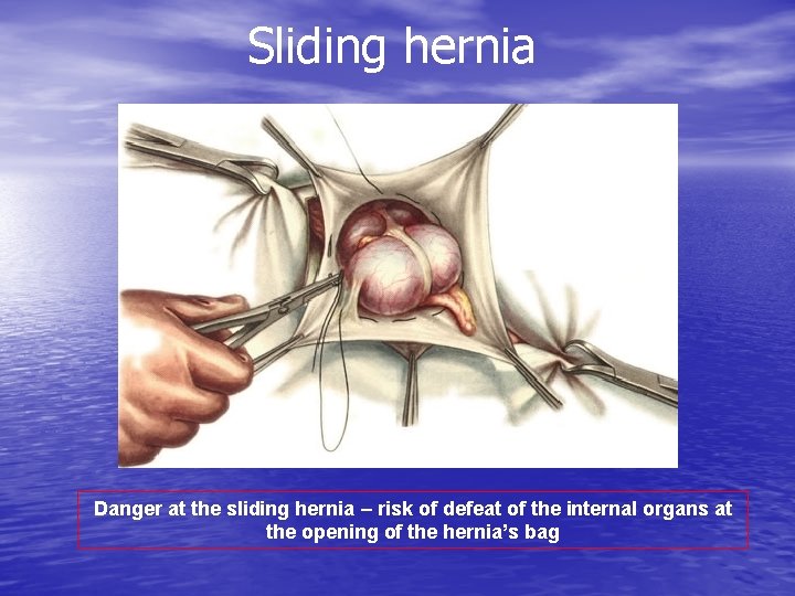 Sliding hernia Danger at the sliding hernia – risk of defeat of the internal