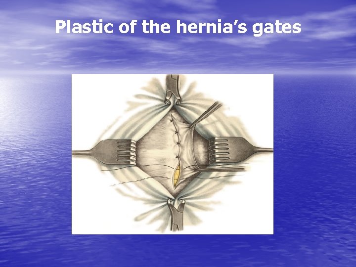 Plastic of the hernia’s gates 