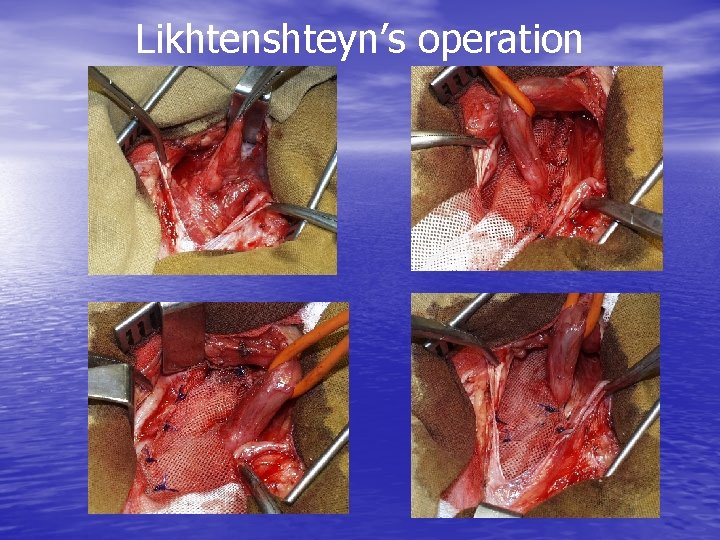 Likhtenshteyn’s operation 