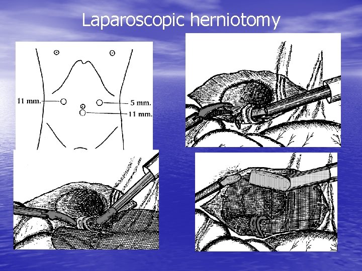 Laparoscopic herniotomy 