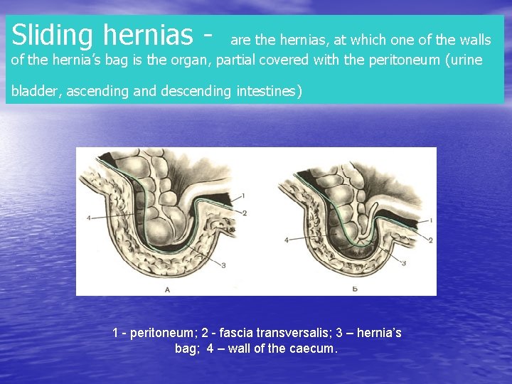 Sliding hernias - are the hernias, at which one of the walls of the