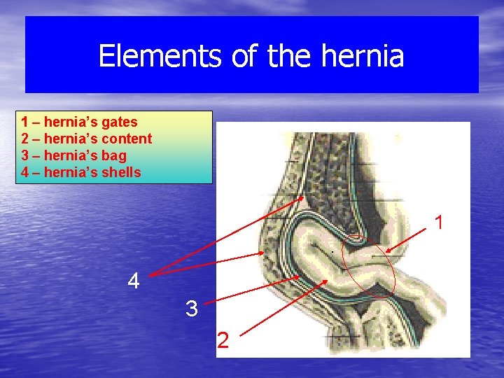 Elements of the hernia 1 – hernia’s gates 2 – hernia’s content 3 –