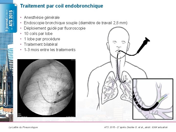 Traitement par coil endobronchique • • Anesthésie générale Endoscopie bronchique souple (diamètre de travail