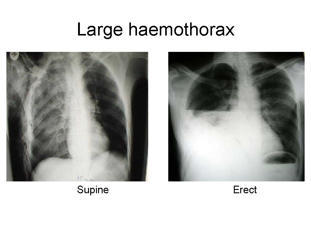 Large haemothorax Supine Erect 