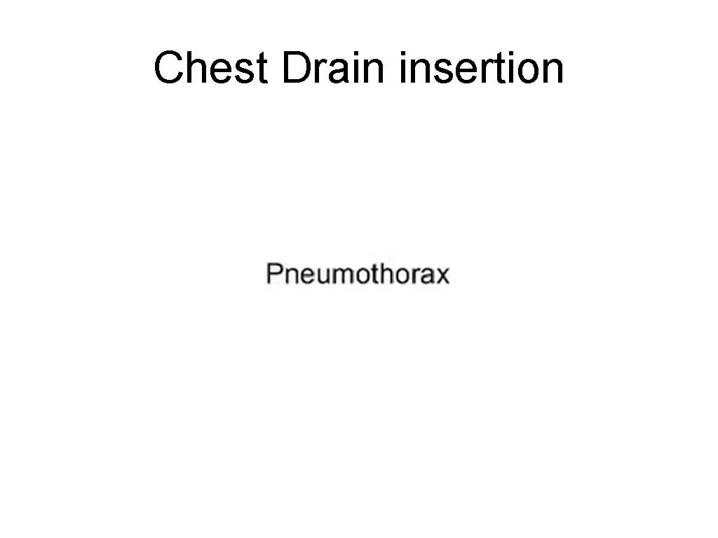 Chest Drain insertion 
