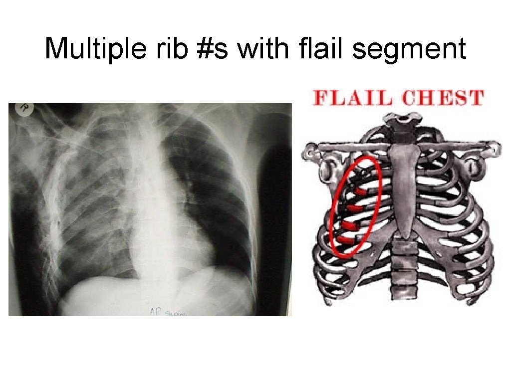 Multiple rib #s with flail segment 