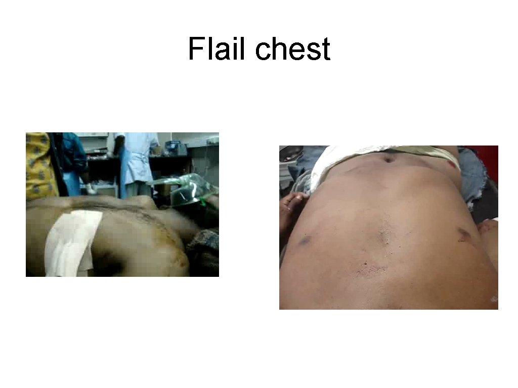 Flail chest 