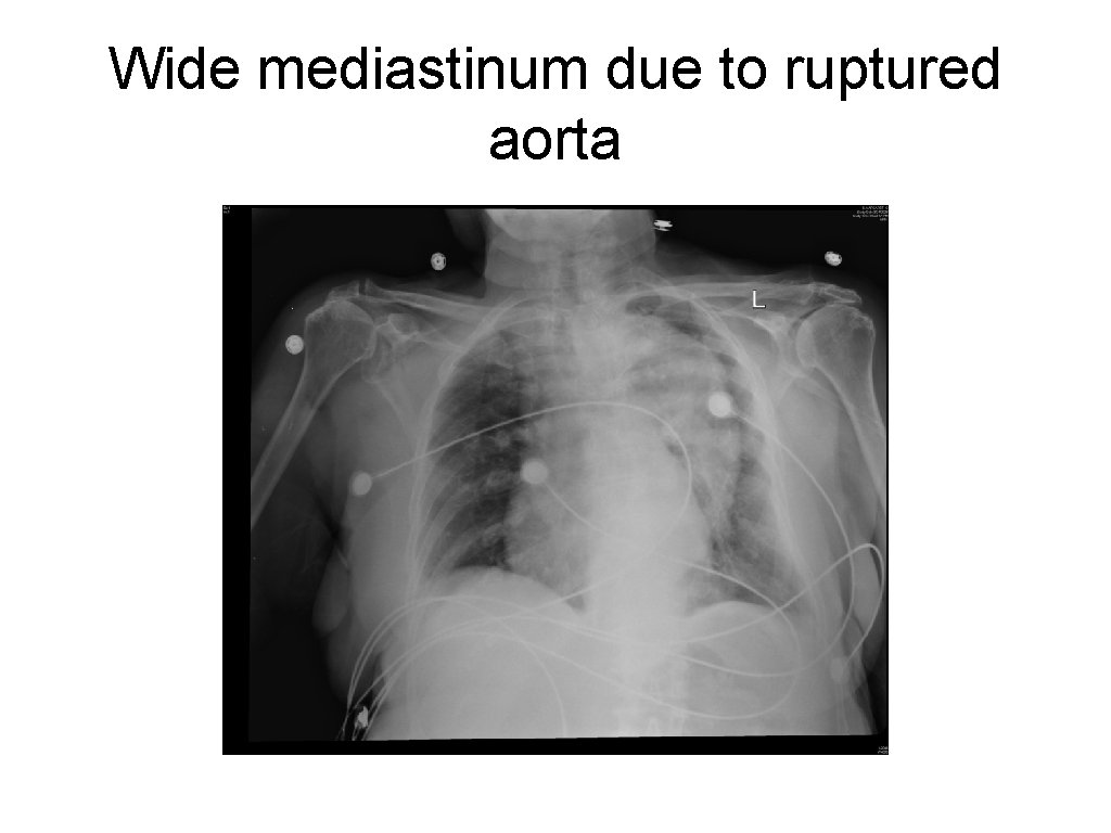 Wide mediastinum due to ruptured aorta 