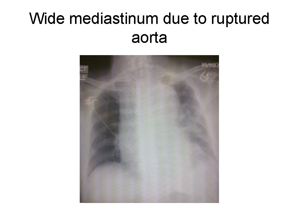 Wide mediastinum due to ruptured aorta 