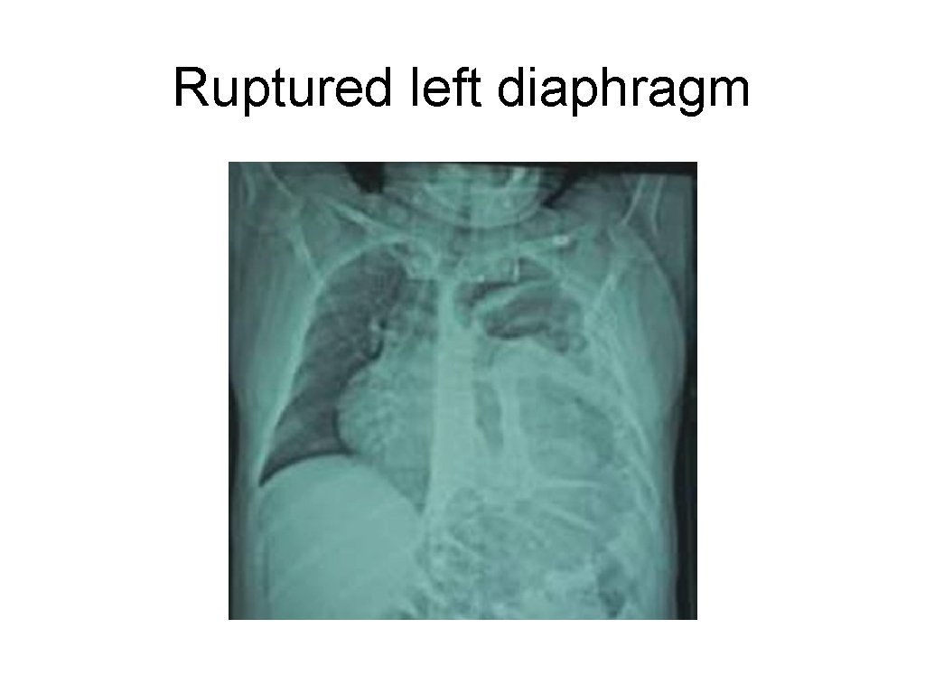 Ruptured left diaphragm 