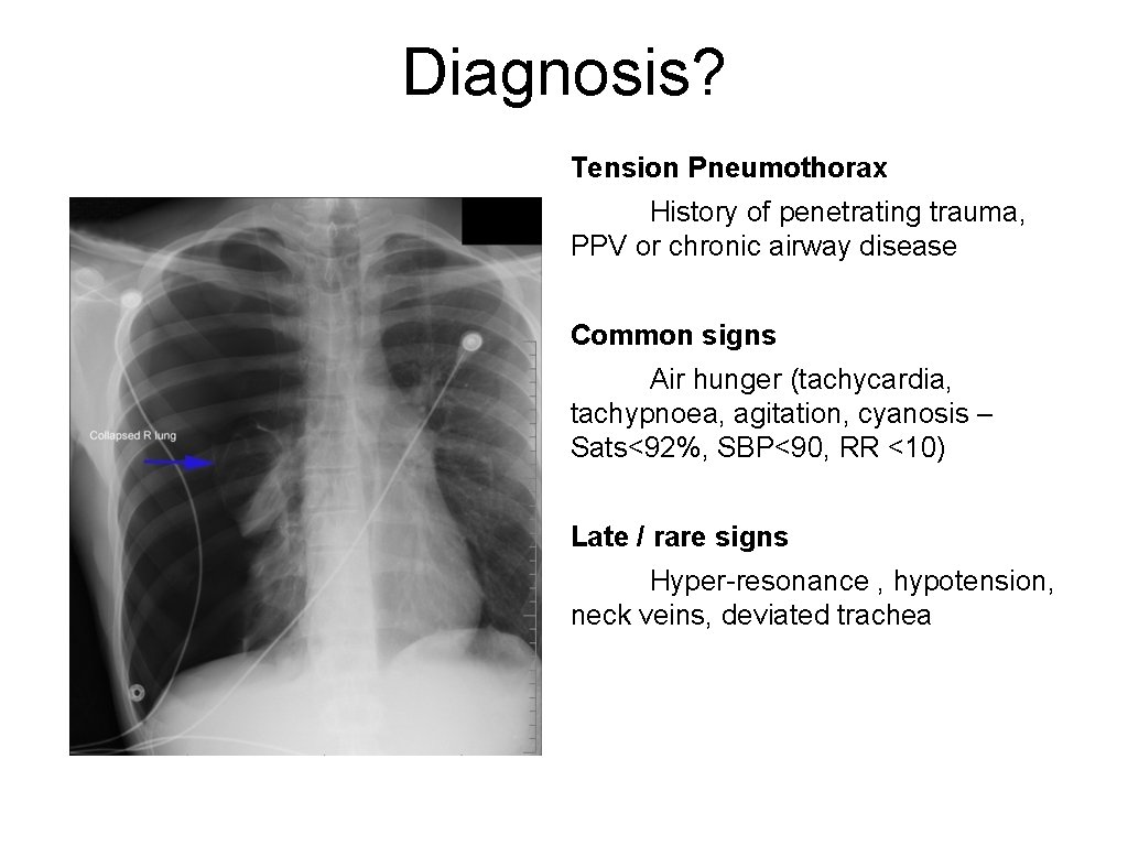 Diagnosis? Tension Pneumothorax History of penetrating trauma, PPV or chronic airway disease Common signs