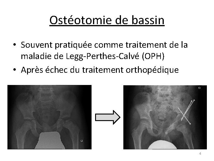 Ostéotomie de bassin • Souvent pratiquée comme traitement de la maladie de Legg-Perthes-Calvé (OPH)