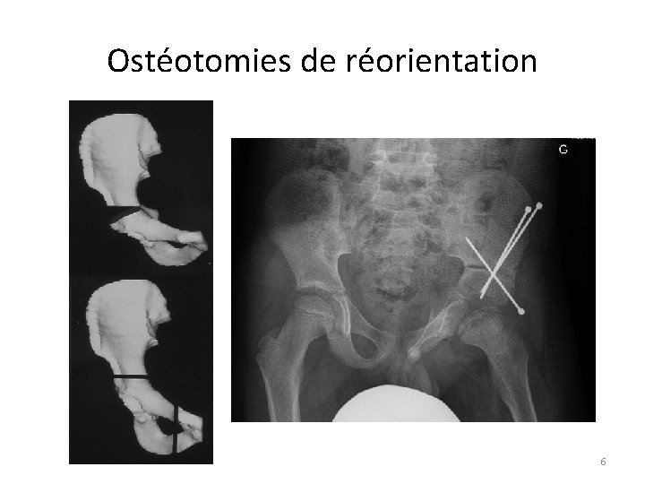 Ostéotomies de réorientation 6 