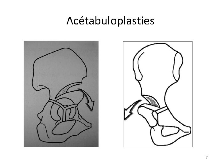 Acétabuloplasties 7 