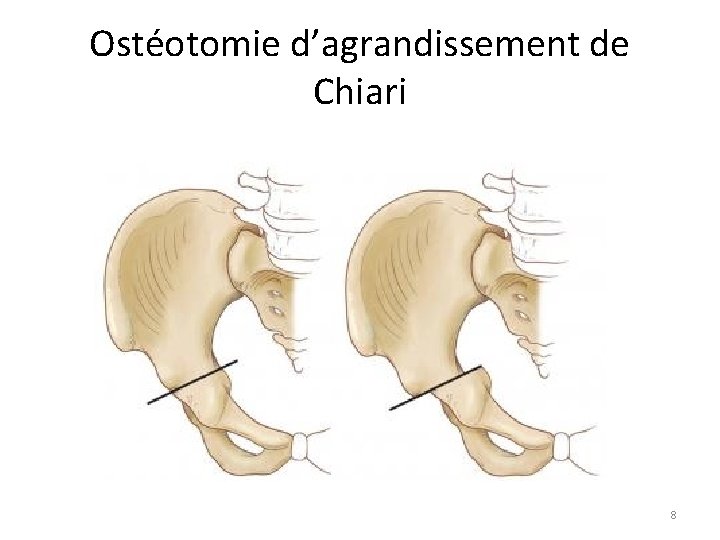 Ostéotomie d’agrandissement de Chiari 8 