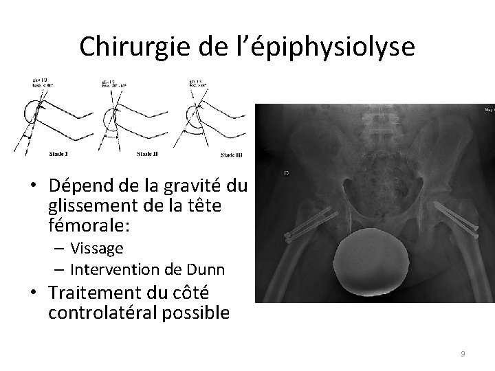 Chirurgie de l’épiphysiolyse • Dépend de la gravité du glissement de la tête fémorale: