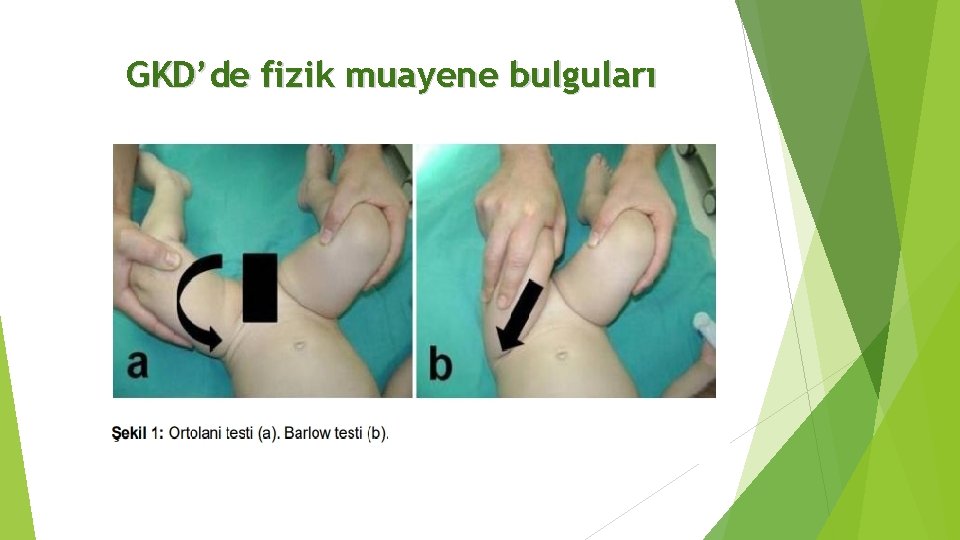 GKD’de fizik muayene bulguları 