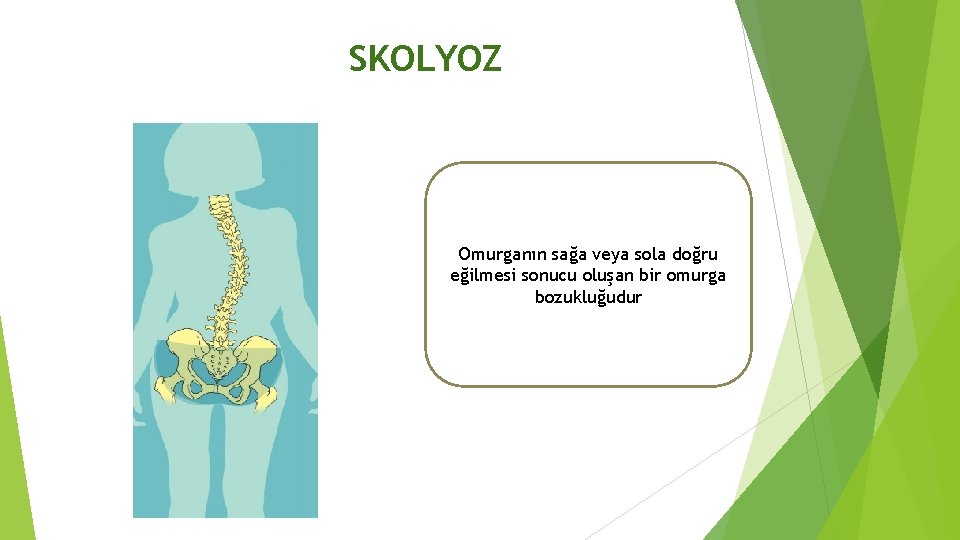 SKOLYOZ Omurganın sağa veya sola doğru eğilmesi sonucu oluşan bir omurga bozukluğudur 