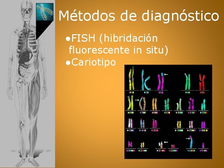 Métodos de diagnóstico ●FISH (hibridación fluorescente in situ) ●Cariotipo 