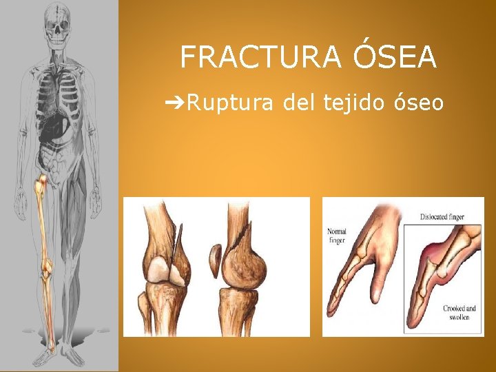 FRACTURA ÓSEA ➔Ruptura del tejido óseo 