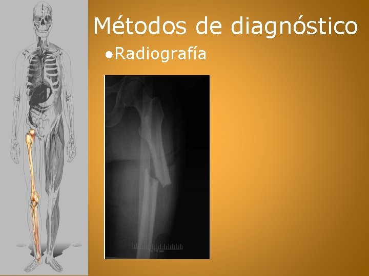 Métodos de diagnóstico ●Radiografía 